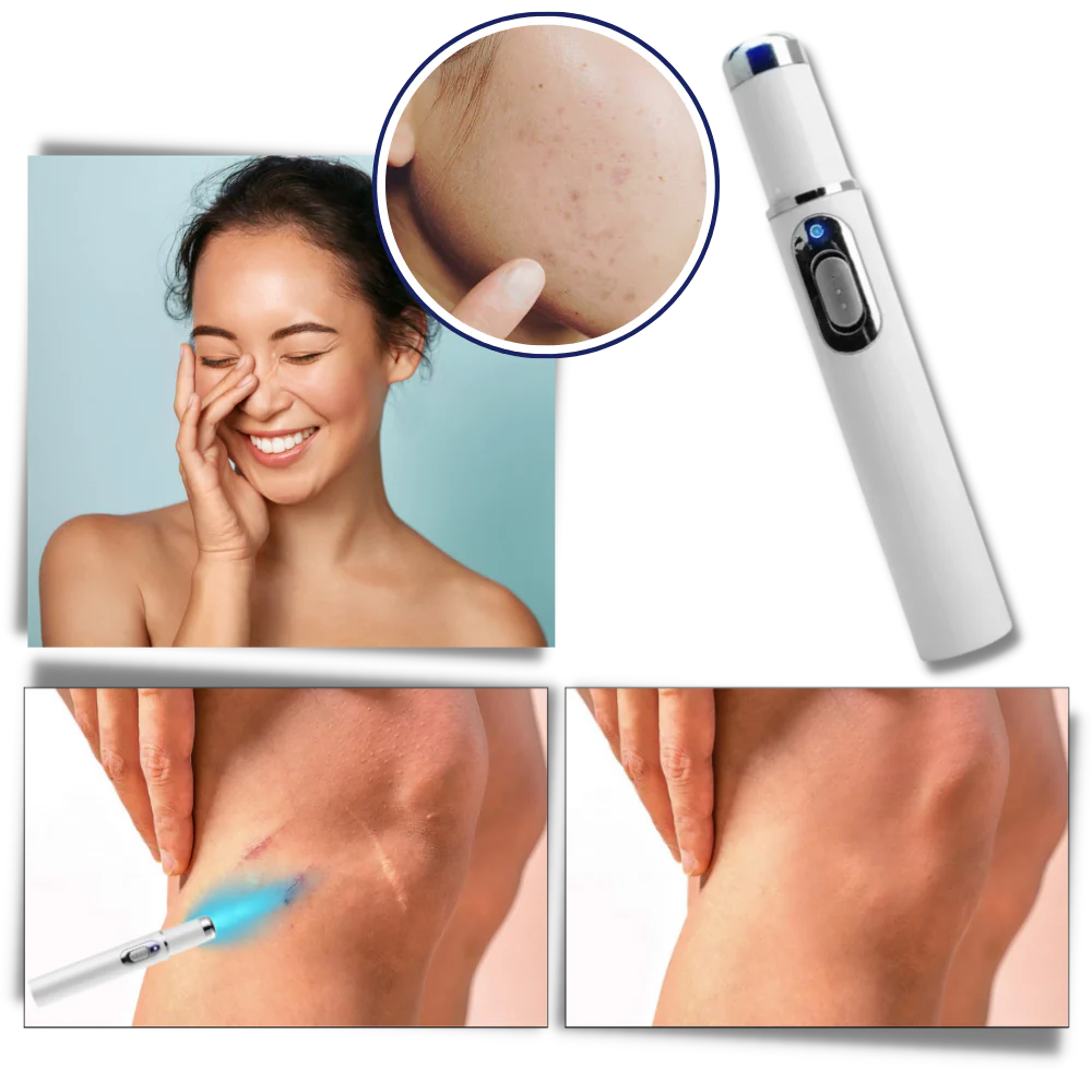 Draagbare Lasertherapie voor een Stralende Teint - Image 2