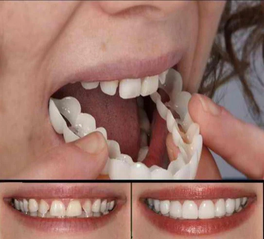 Fitflex Opzet Gebit - Image 2